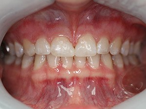 Person with aligned teeth