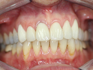 Person with clear white teeth