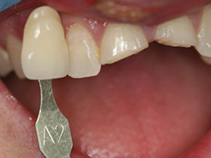 Person with damaged front teeth