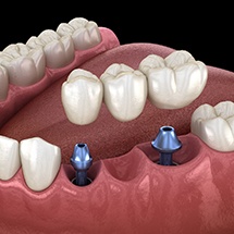 two dental implants holding a dental bridge 