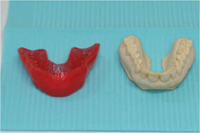Front view of proform mouthguard and model teeth